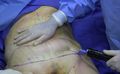 1280px-Fat removal using cannula during tumescent liposuction.jpg